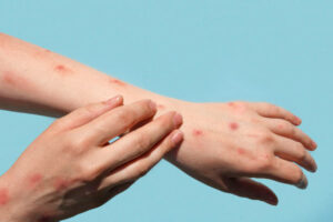 Allergy UK hopes the abolition of NHS England can lead to more specialist allergy care in the community